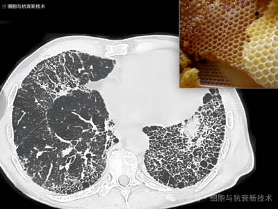 外泌體霧化可治療肺部結(jié)節(jié)及肺纖維化