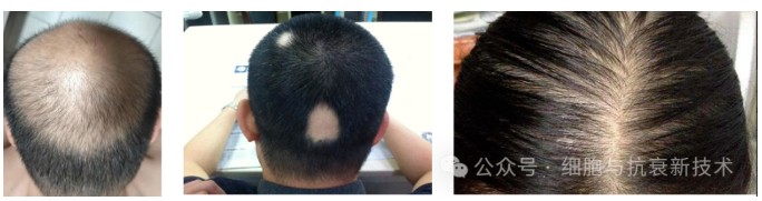 干細(xì)胞外泌體在生發(fā)領(lǐng)域的應(yīng)用