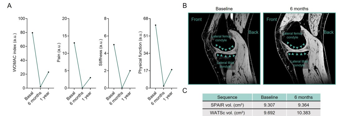 對股骨軟骨進行人工分割獲得的定量容積分析